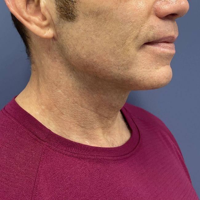 image after myellevate - male adult patient 45 degrees right angle case 6455