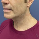 image after myellevate - male adult patient 45 degrees left angle case 6455
