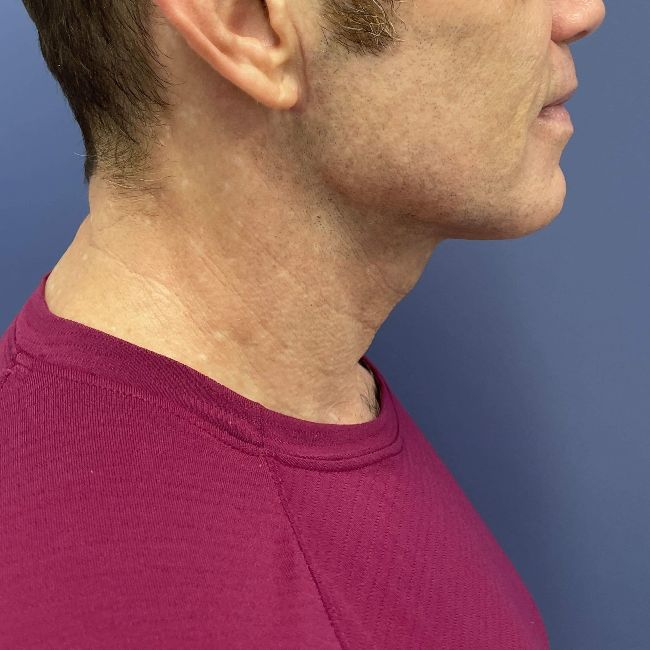 image after myellevate - male adult patient right angle case 6455