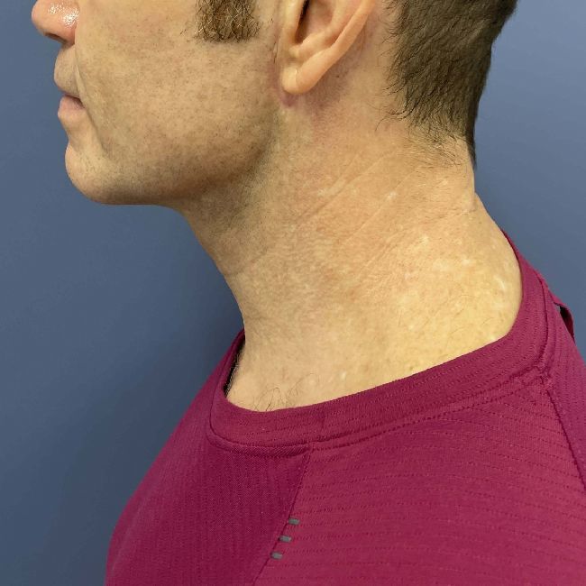 image after myellevate - male adult patient left angle case 6455