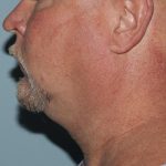 image before myellevate - minimally invasive neck lift left angle case 6452