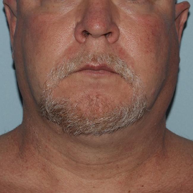image before myellevate - minimally invasive neck lift front view case 6452