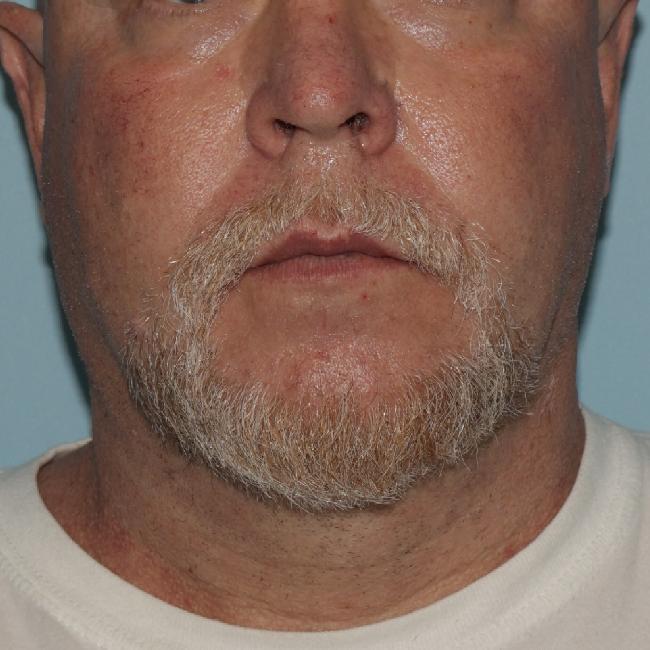 image after myellevate - minimally invasive neck lift front view case 6452