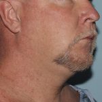 image before myellevate - minimally invasive neck lift 45 degrees right angle case 6452