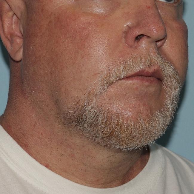 image after myellevate - minimally invasive neck lift 45 degrees right angle case 6452