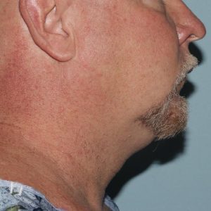 image before myellevate - minimally invasive neck lift right angle case 6452