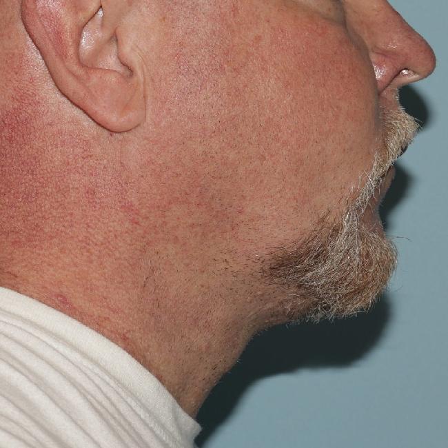 image after myellevate - minimally invasive neck lift right angle case 6452