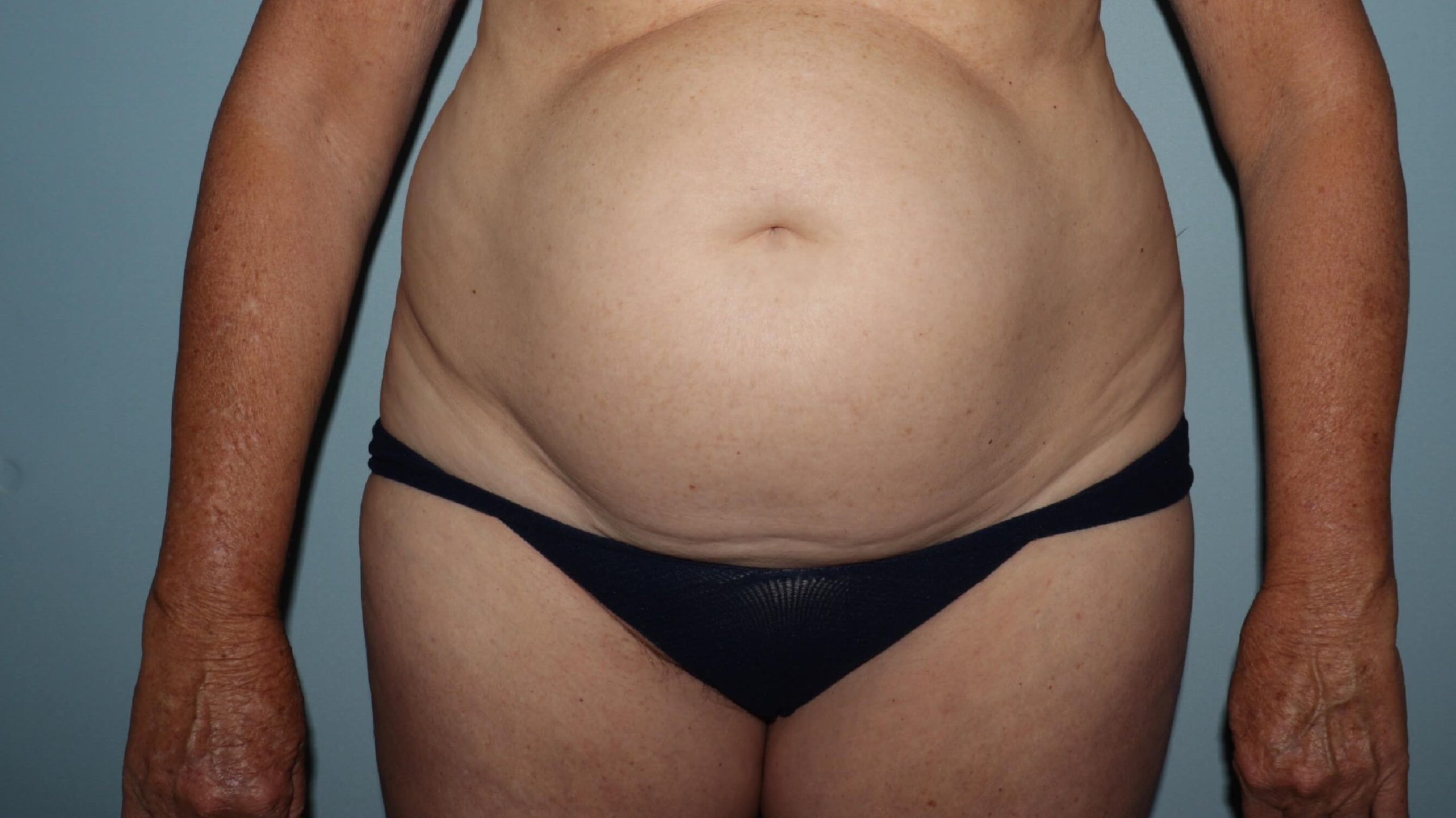 TummyTuck After Age 50: Am I Too Old for Abdominoplasty? The Answer is No!