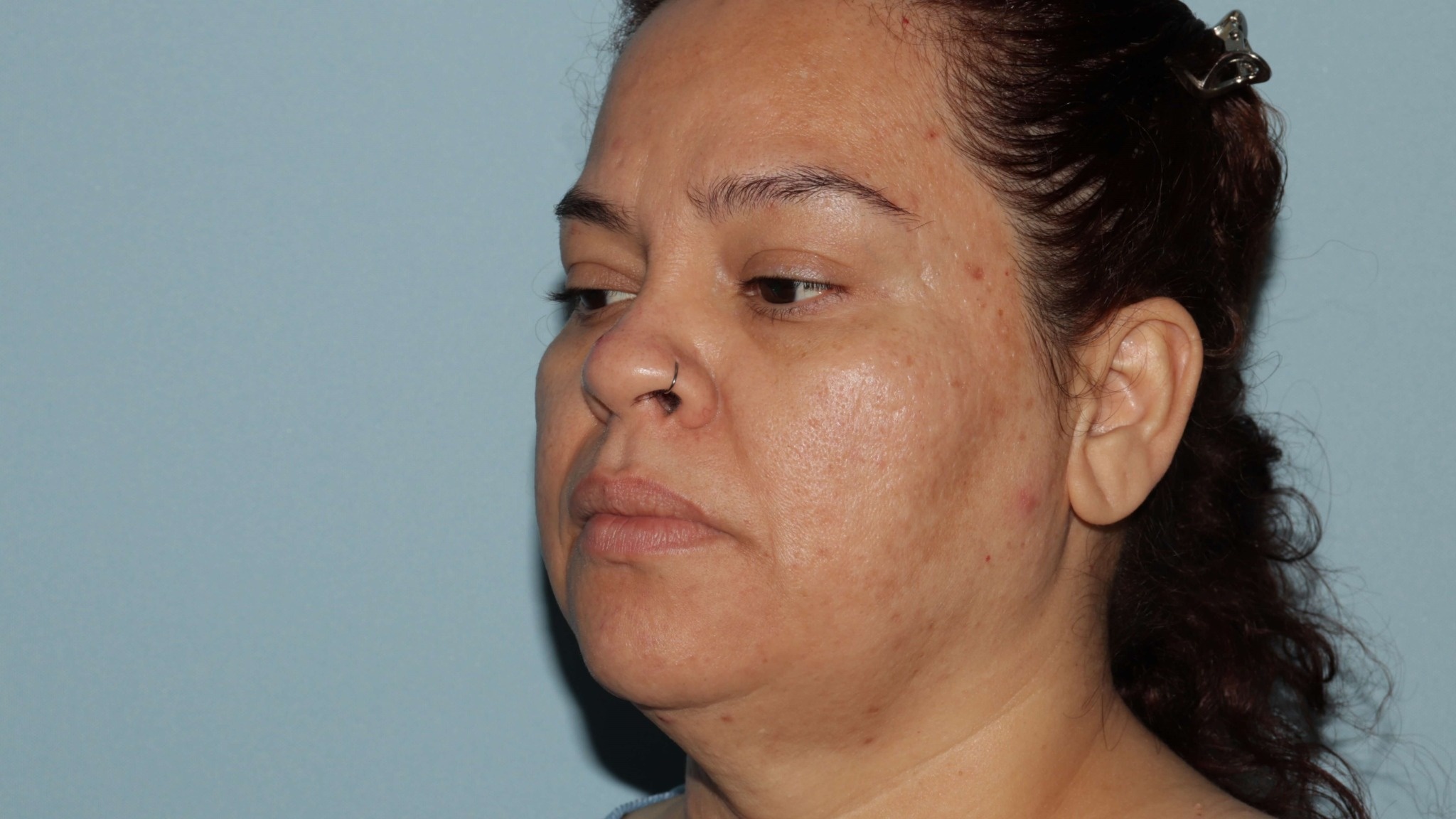My Ellevate : Minimally Invasive Neck lift-Great Technology with Limitations