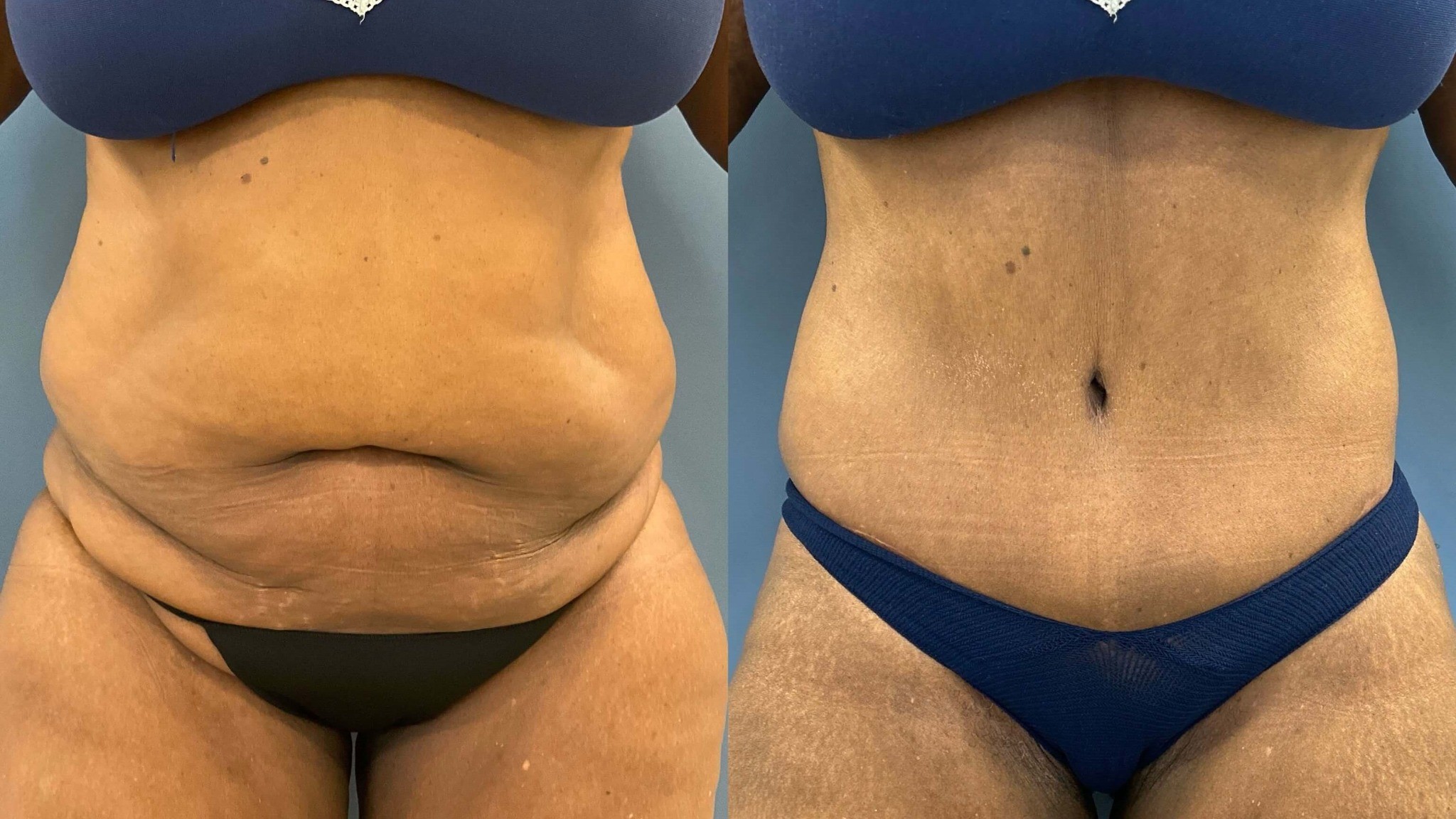 Higher Risk Abdominoplasty in Raleigh, NC