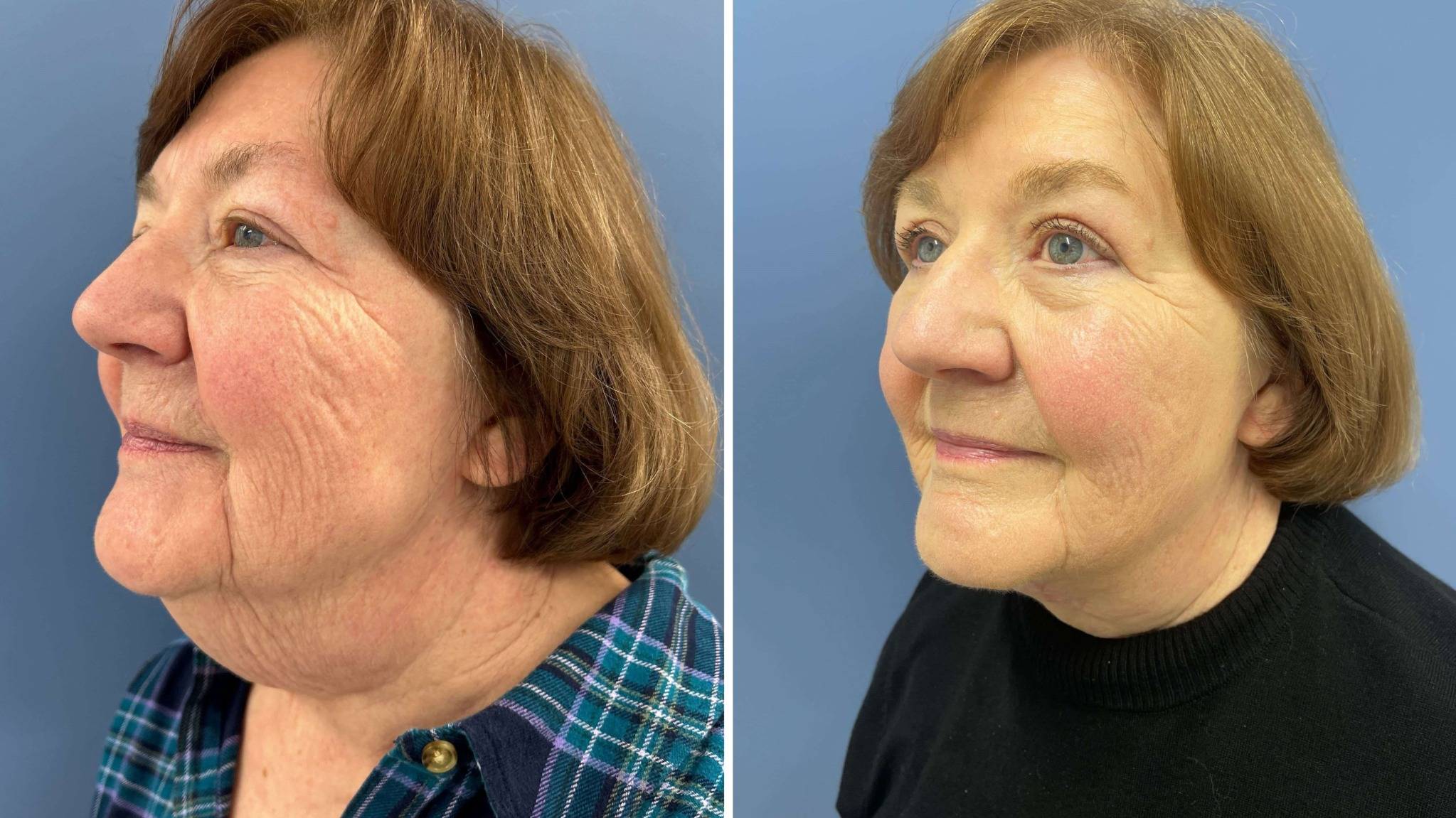 Rejuvenation in High Risk Patients-Direct Neck lift and Upper Blepharoplasty