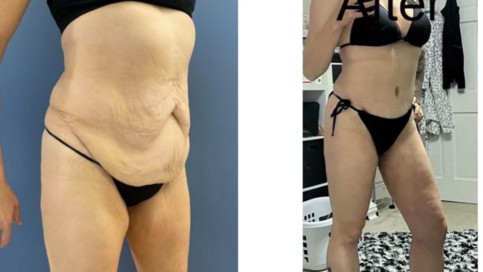 When Can I exercise After Tummy Tuck?