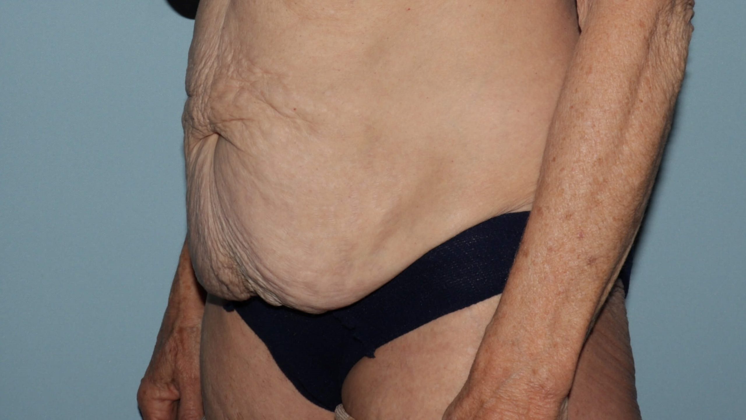 What is the age limit for a tummy tuck? 5 things to consider after age 50.