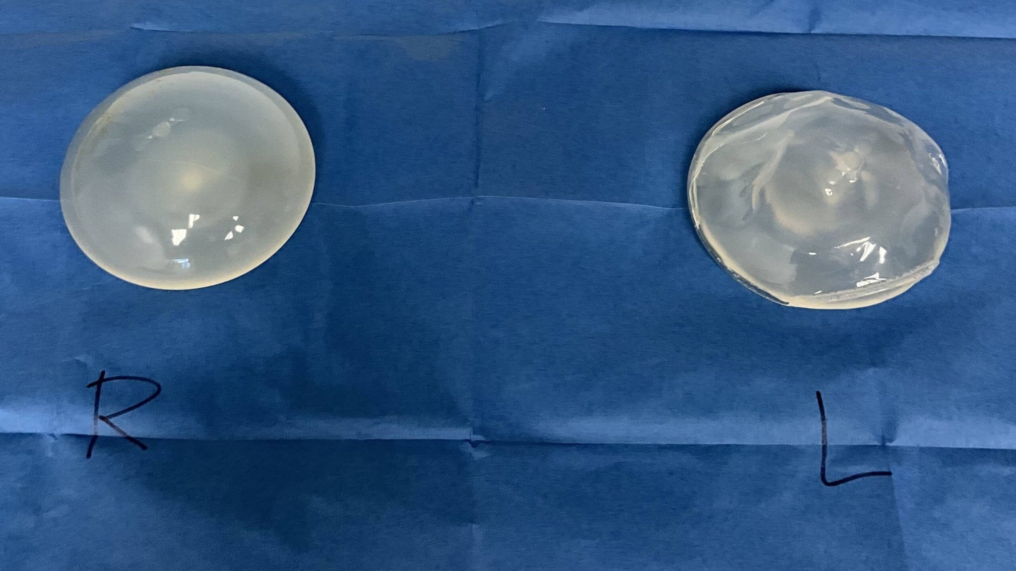 Ideal Implants- What Do you Do If you Have Them?
