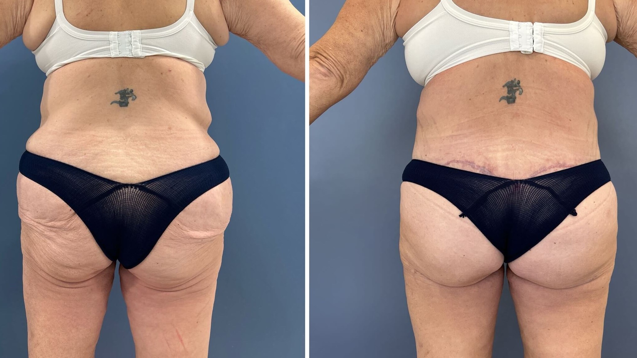 Thigh Lift and Body Lift Combo Improves Tummy , Back and Thighs, Raleigh, NC