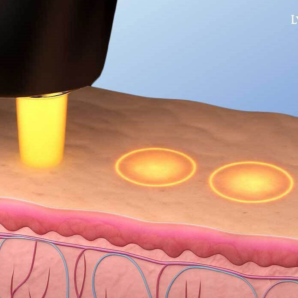 NeoGen: How Nitrogen Plasma Regenerates Your Skin Naturally