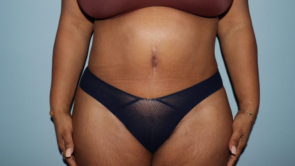 after tummy tuck front view female patient Raleigh, NC