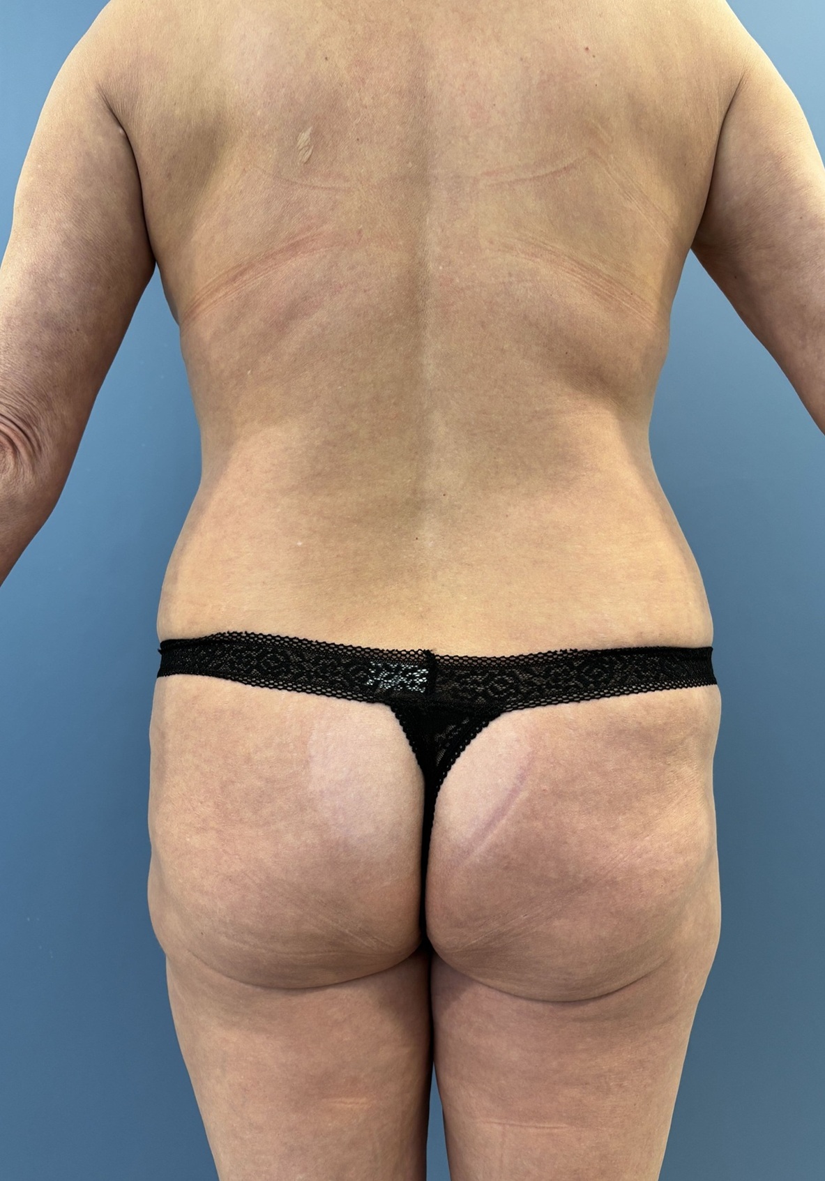 Before Mommy Makeover with C-Sections Before and After - back Side View Case 13757