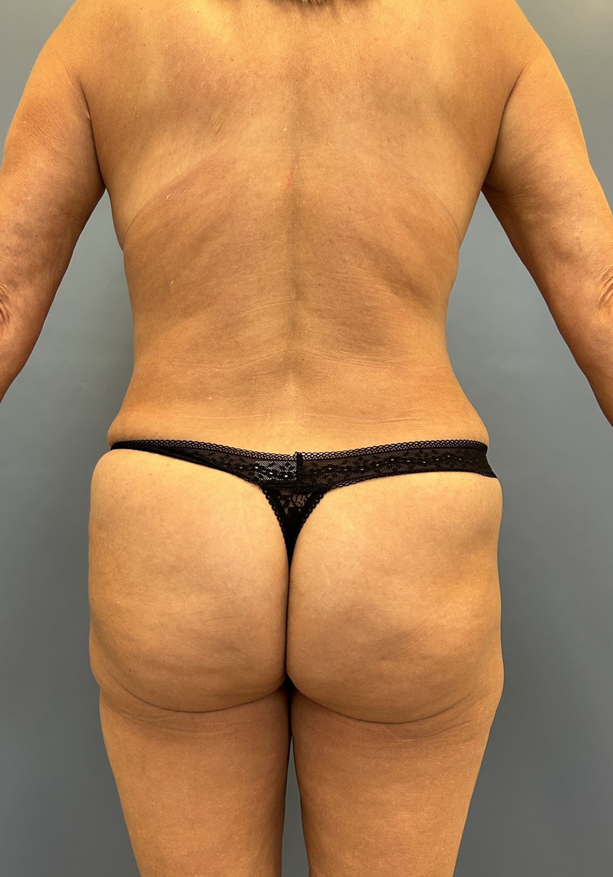 After Mommy Makeover with C-Sections Before and After - Back Side View Case 13758