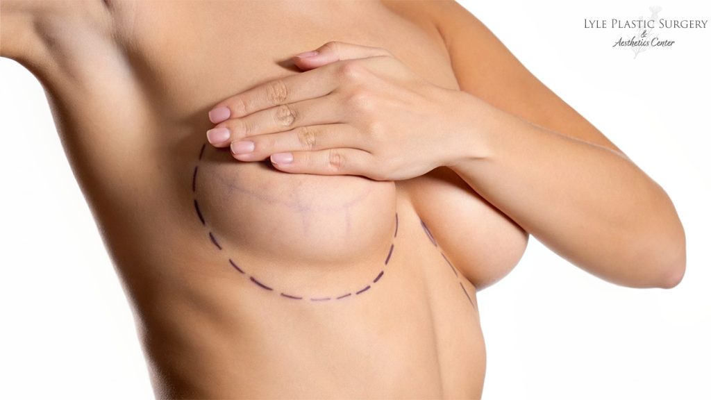 How to Minimize Breast Lift Scars: Expert Tips and Techniques by Dr Glenn Lyle