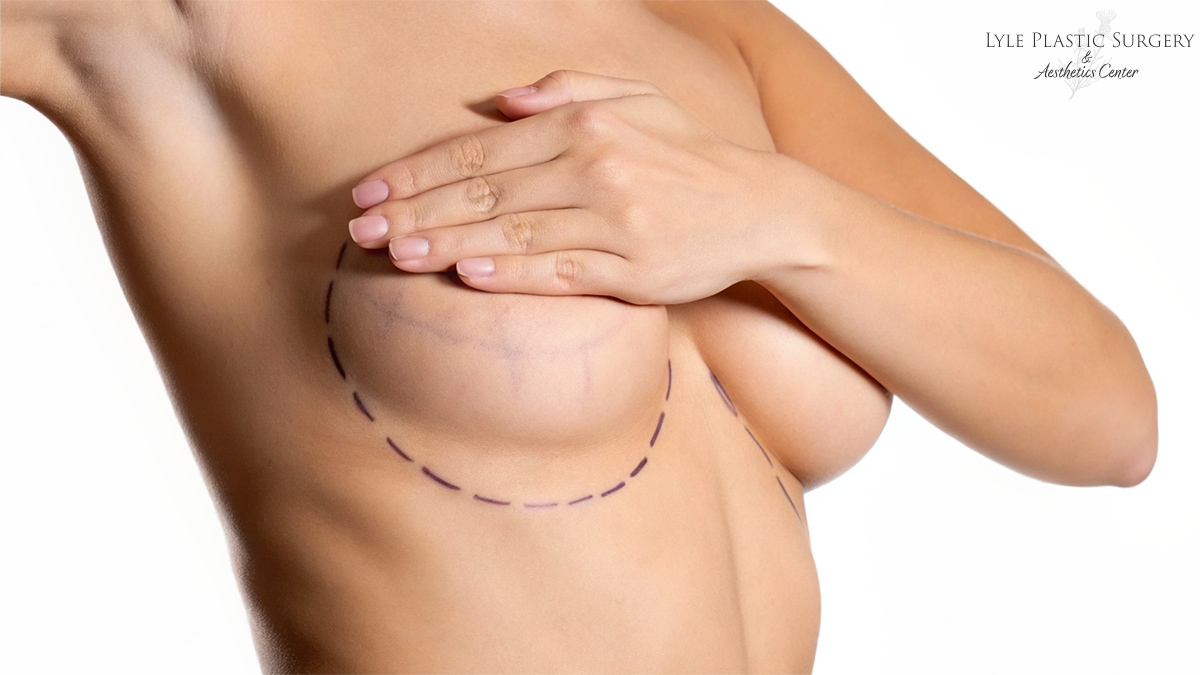 How to Minimize Breast Lift Scars: Expert Tips and Techniques