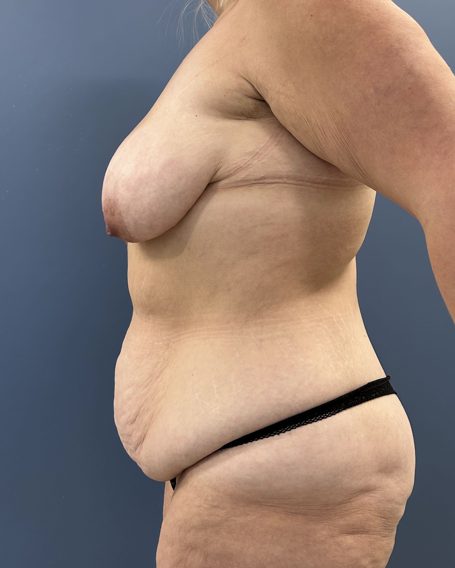 After Weight Loss Surgery Before and After Photo - Left Side View Case 14602